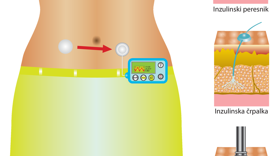 S Diabetesom