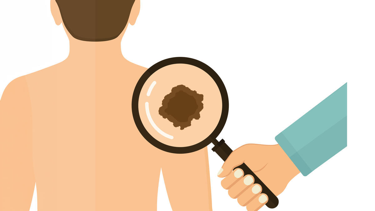 Nemelanomski rak: Ne smemo ga spregledati